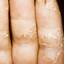 185. Dry Eczema on Hands Pictures