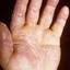 186. Dry Eczema on Hands Pictures