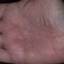 192. Dry Eczema on Hands Pictures