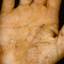 194. Dry Eczema on Hands Pictures