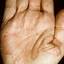 205. Dry Eczema on Hands Pictures