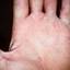 206. Dry Eczema on Hands Pictures
