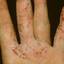 210. Dry Eczema on Hands Pictures
