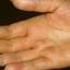 211. Dry Eczema on Hands Pictures