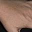 212. Dry Eczema on Hands Pictures