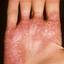 213. Dry Eczema on Hands Pictures