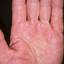 214. Dry Eczema on Hands Pictures