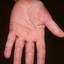 218. Dry Eczema on Hands Pictures