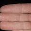 223. Dry Eczema on Hands Pictures