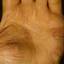 225. Dry Eczema on Hands Pictures
