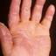 230. Dry Eczema on Hands Pictures