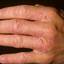 231. Dry Eczema on Hands Pictures