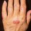 233. Dry Eczema on Hands Pictures