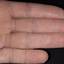 234. Dry Eczema on Hands Pictures
