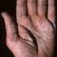 238. Dry Eczema on Hands Pictures