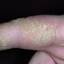 24. Dry Eczema on Hands Pictures
