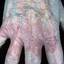 242. Dry Eczema on Hands Pictures