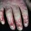 244. Dry Eczema on Hands Pictures