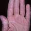 251. Dry Eczema on Hands Pictures