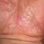 257. Dry Eczema on Hands Pictures