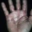 259. Dry Eczema on Hands Pictures