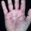 260. Dry Eczema on Hands Pictures