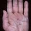 263. Dry Eczema on Hands Pictures