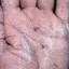 265. Dry Eczema on Hands Pictures