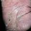 271. Dry Eczema on Hands Pictures