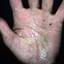 272. Dry Eczema on Hands Pictures