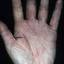 274. Dry Eczema on Hands Pictures