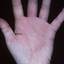276. Dry Eczema on Hands Pictures