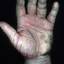 277. Dry Eczema on Hands Pictures