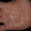 278. Dry Eczema on Hands Pictures