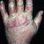 279. Dry Eczema on Hands Pictures