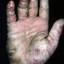 280. Dry Eczema on Hands Pictures