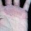 282. Dry Eczema on Hands Pictures