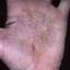 285. Dry Eczema on Hands Pictures