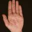291. Dry Eczema on Hands Pictures