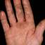 292. Dry Eczema on Hands Pictures