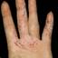 293. Dry Eczema on Hands Pictures