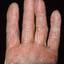 294. Dry Eczema on Hands Pictures