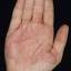 298. Dry Eczema on Hands Pictures