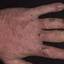 30. Dry Eczema on Hands Pictures