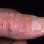 301. Dry Eczema on Hands Pictures