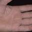 305. Dry Eczema on Hands Pictures