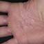 308. Dry Eczema on Hands Pictures
