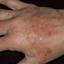 311. Dry Eczema on Hands Pictures