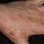 312. Dry Eczema on Hands Pictures