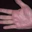 314. Dry Eczema on Hands Pictures